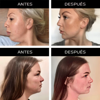 Fluencee® | Rejuvenecedor Facial y Reductor de Papada